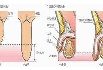 北京阴茎延长术视频,技术革新与术后恢复全解析